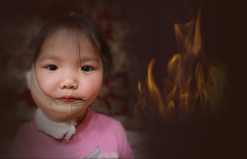 Save the burned child in Mogolia